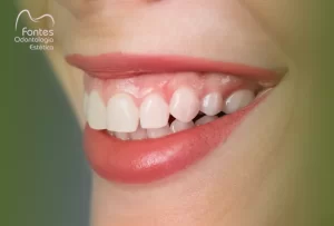 dentista-cirurgia-estetica-gengival-ipanema-clinica-fontes-odontologia
