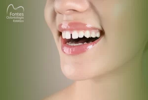 fechar-espaco-dentes-diastema-ipanema