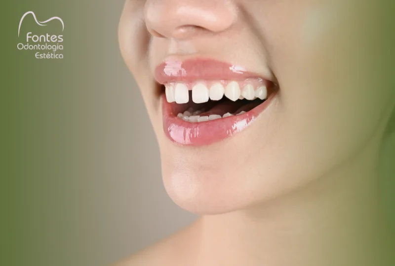 fechar-espaco-dentes-diastema-ipanema
