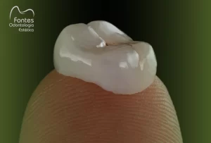 colocar-coroa-dentaria-ipanema-dentista-fontes-odonto
