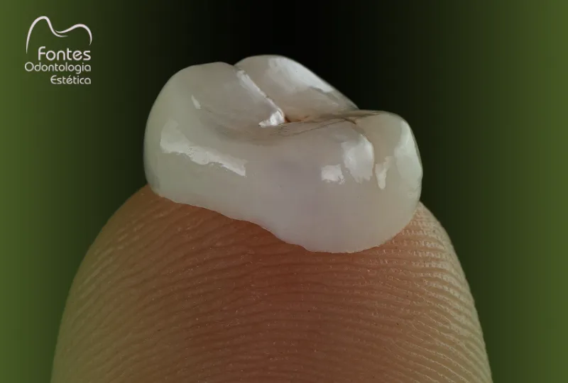 colocar-coroa-dentaria-ipanema-dentista-fontes-odonto