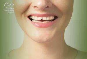 restaurar-dente-quebrado-ipanema-dentista-pedro-fontes-odontologia