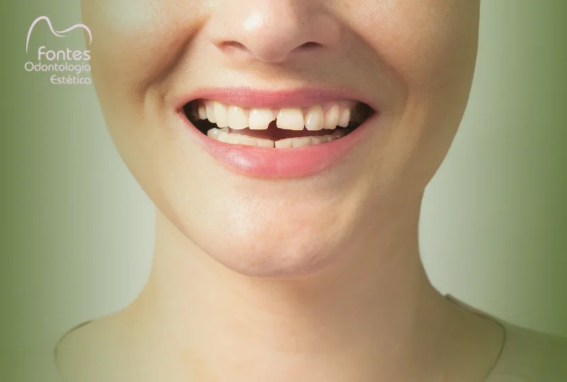 restaurar-dente-quebrado-ipanema-dentista-pedro-fontes-odontologia
